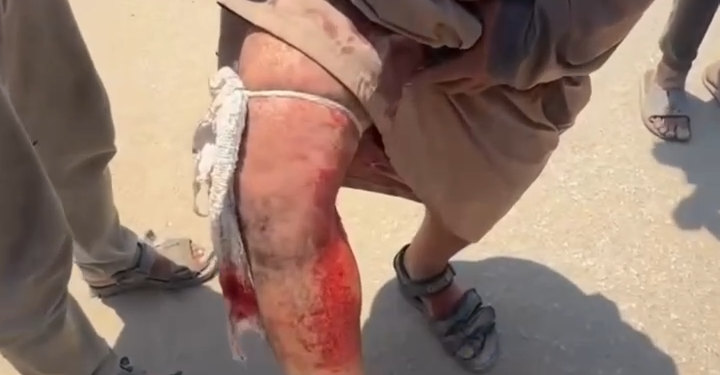 “Bu yardım deyil, bu qan içində ölümdür” – yaralı fələstinli ata danışır