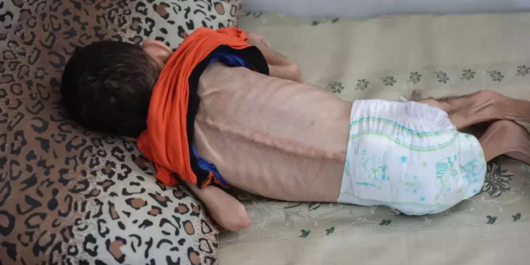 İşğalın körpə südünün Qəzzaya girişini əngəlləməsi səbəbindən körpələrin kütləvi ölümü ilə bağlı xəbərdarlıq