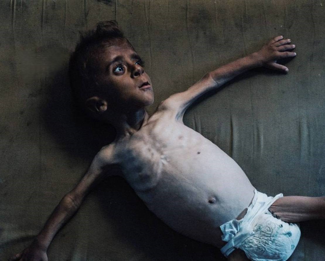 Aclıq bədənləri yeyir… Qəzzada aclıq səbəbindən 7 yeni ölüm, aralarında bir uşaq da var